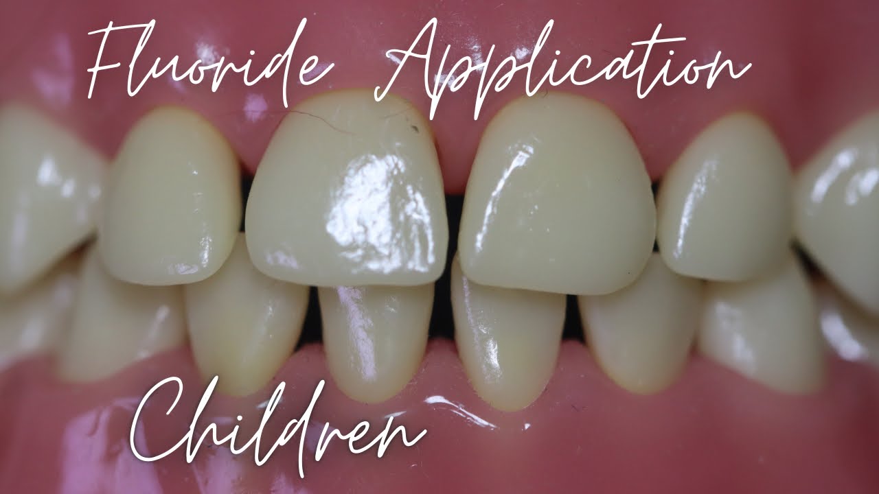 Fluoride Treatment in Children🟠Embrace Fluoride Varnish🟣