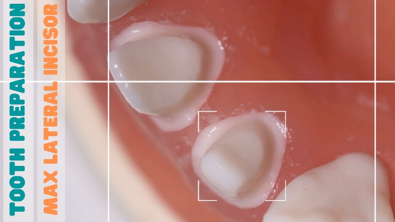 Tooth Preparation 🔵 Maxillary Lateral Incisor 🟡 PFM