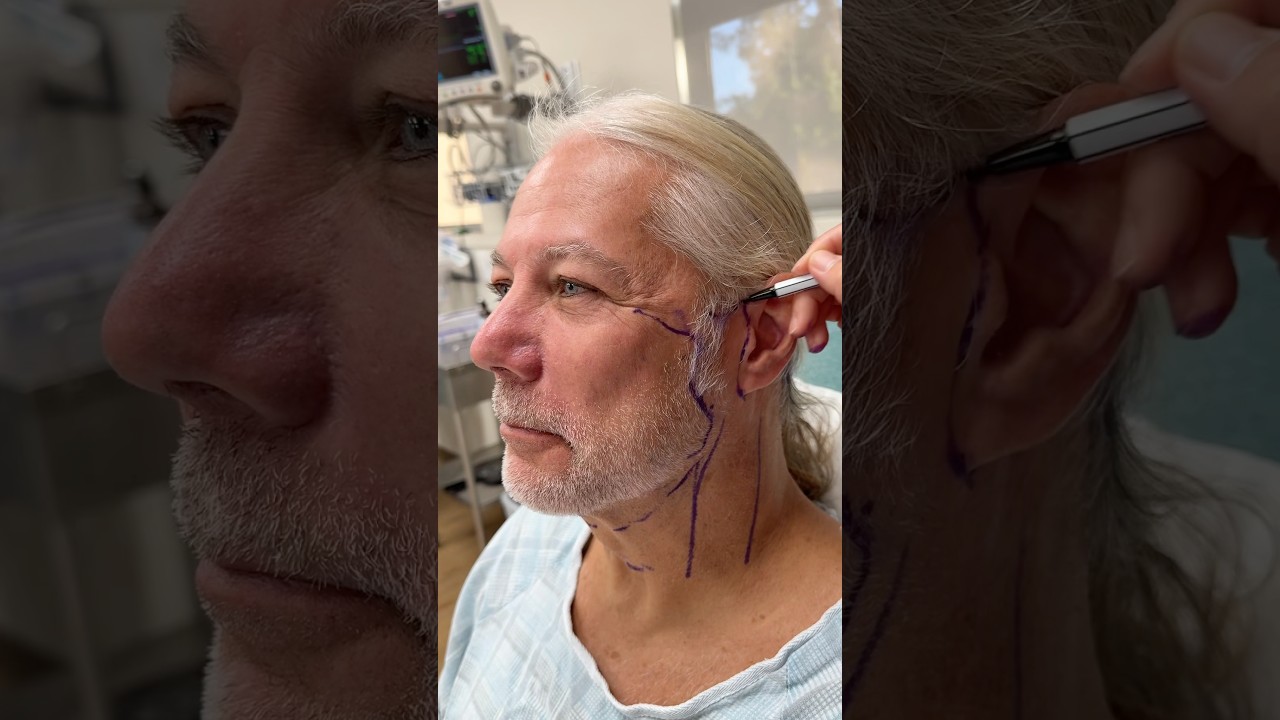 POV: Day Of Your Deep Neck Facelift (Interview)