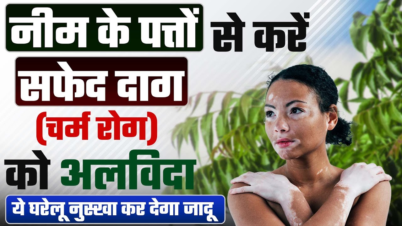 सफेद दाग में क्या लगाना चाहिए? | नीम के पत्ते से करें घर बैठे सफेद दाग को ठीक ! Safed daag ka upay