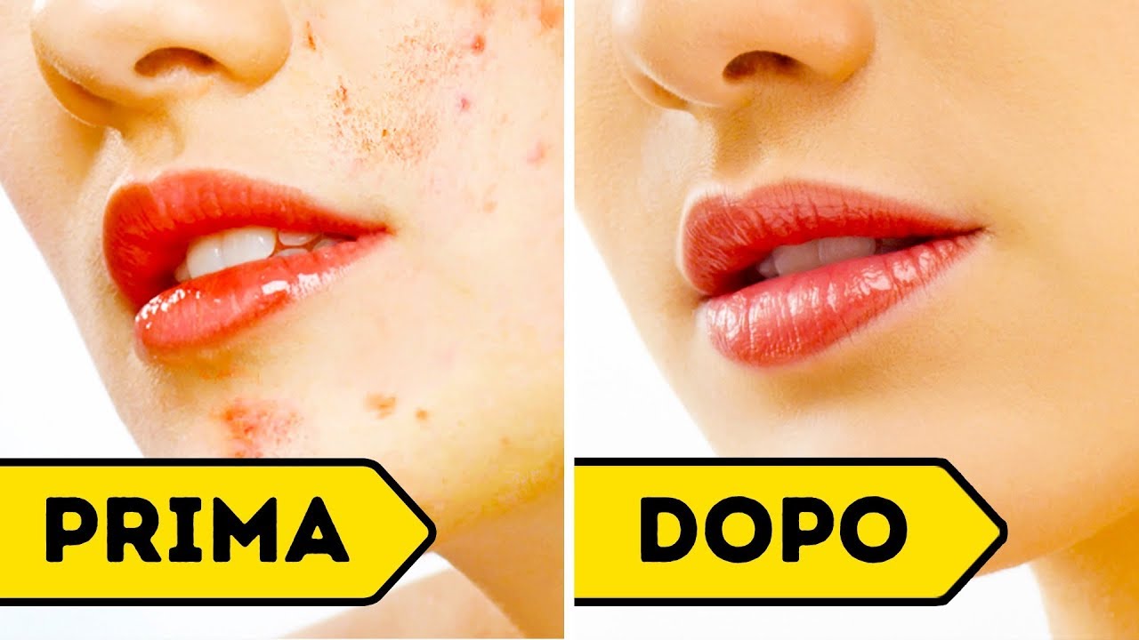 Come Eliminare le Cicatrici da Acne in Soli 3 Giorni