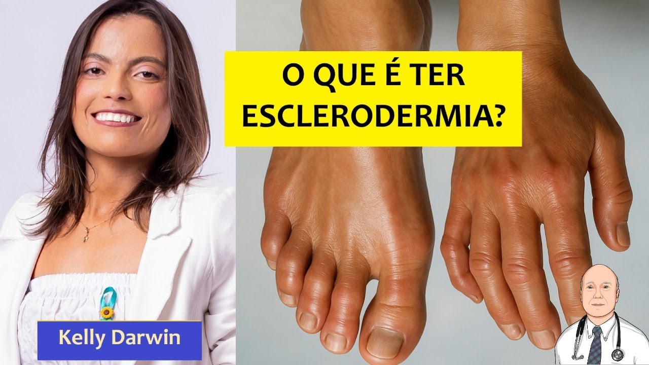 As experiências de vida de quem tem esclerodermia. Como é ter esclerose sistêmica?