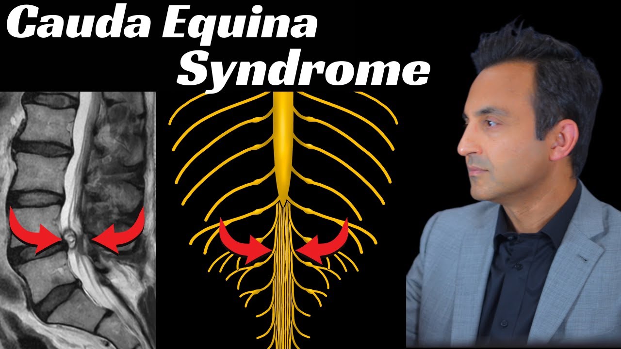 Cauda Equina Syndrome