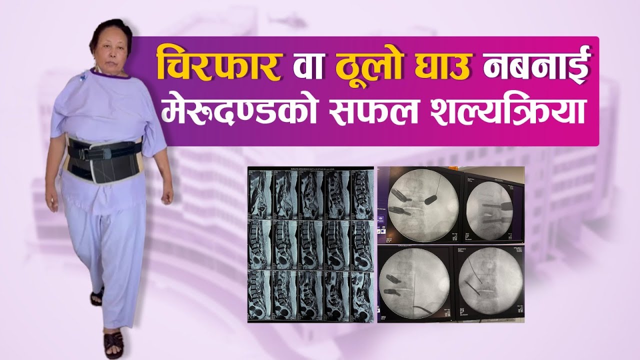 बाथरुममा लडेर हिँड्डुल गर्न समस्या भएपछि नेपाल मेडिसिटी आएकी सञ्जय गुरुङको Spine Fusion शल्यक्रिया