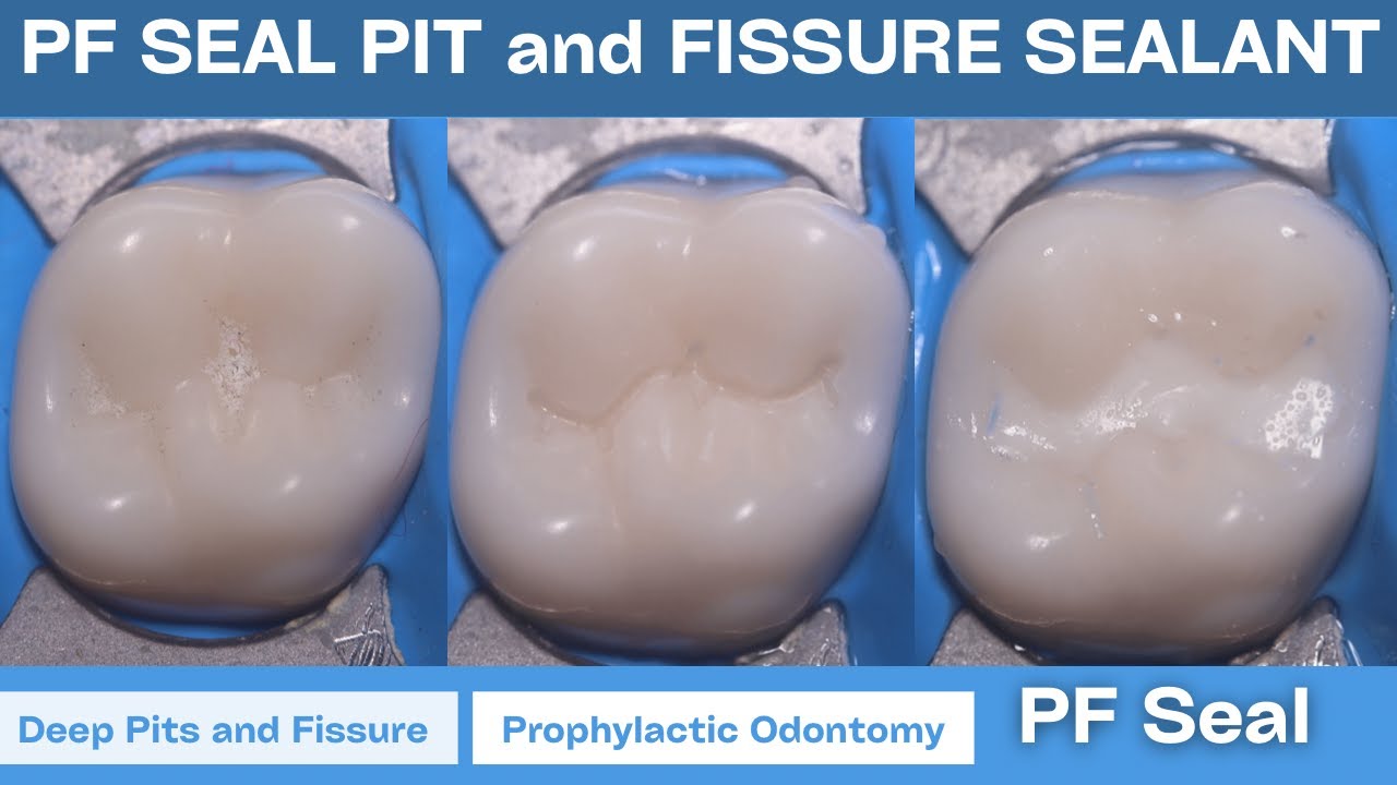 PF SEAL || Light Cure Pit and Fissure Sealant || Procedure in Maxillary Molar