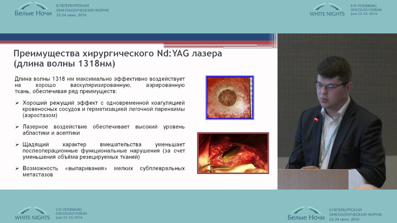 Surgery is the treatment of multiple lung metastases