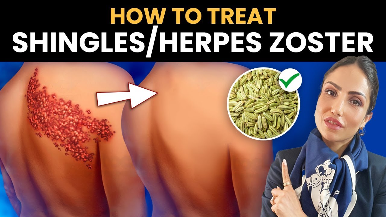 How to NEVER Get Shingles Again | Herpes Zoster | 2023