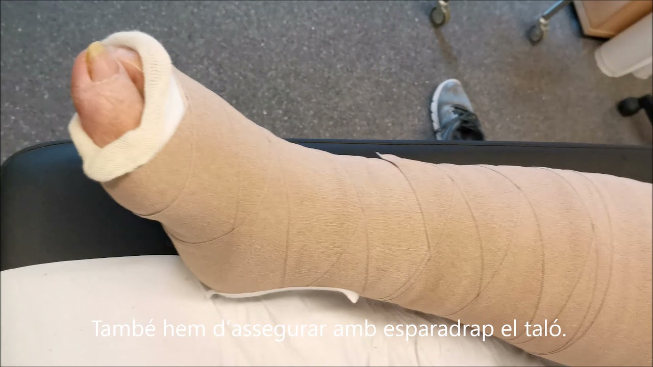 Vendaje multicomponente para lipodermatoesclerosis marcadas - Terapia compresiva