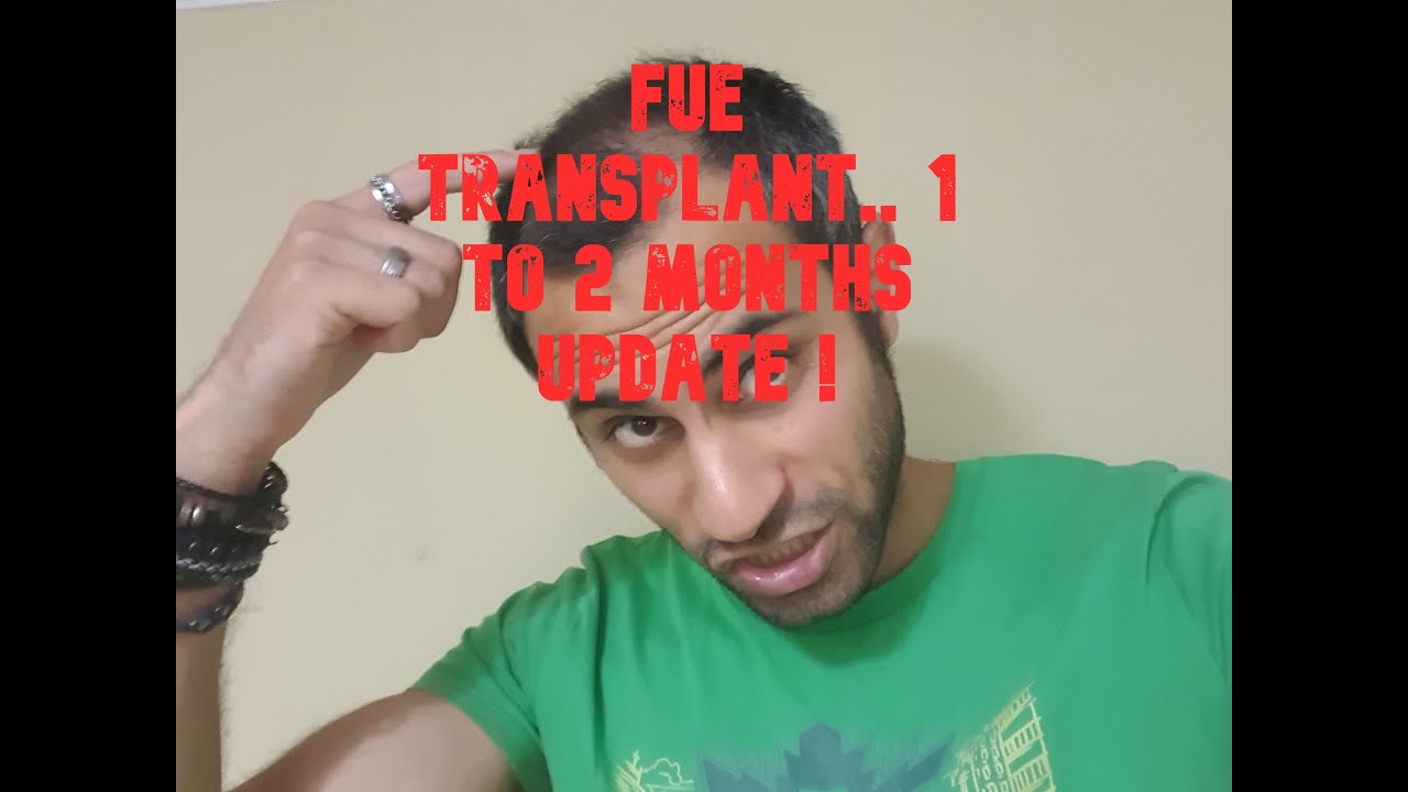 HAIR GROWTH CENTRE LONDON. MAIDA VALE.  FUE TRANSPLANT CROWN TIMELINE. 1-2 MONTHS.