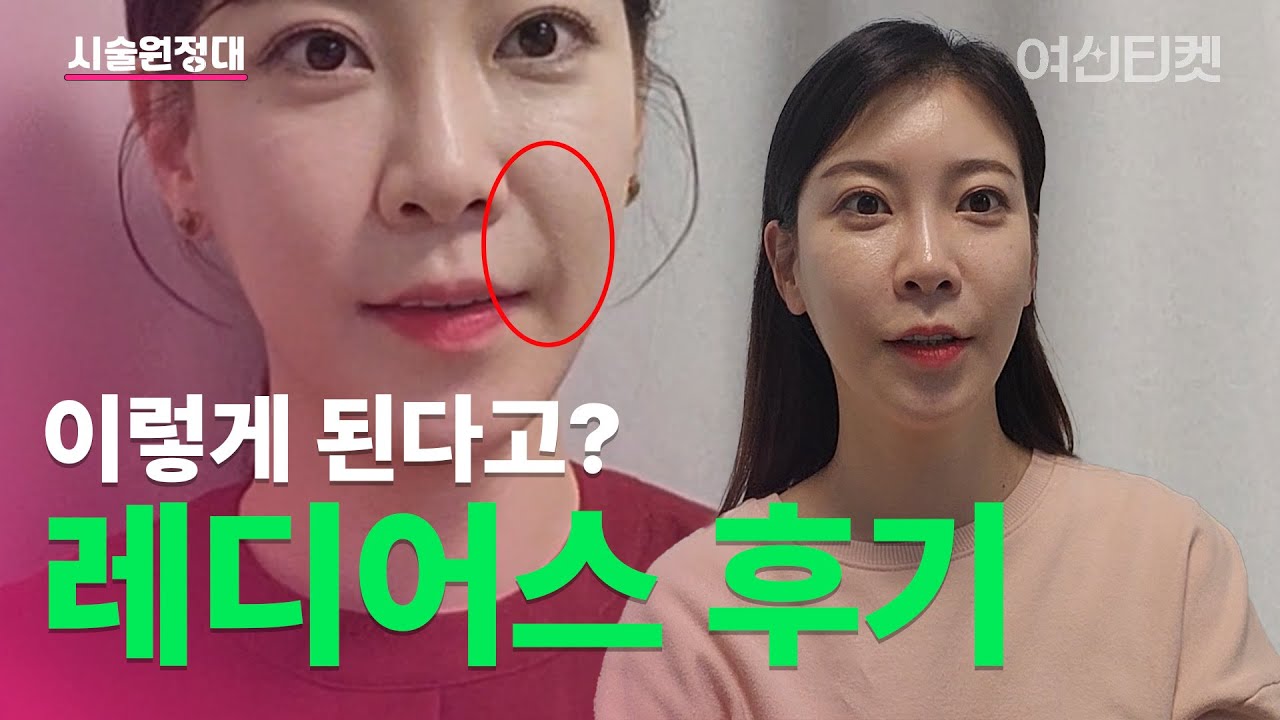 붓기 다 빠진 4주차! 레디어스 최종 결과 공개