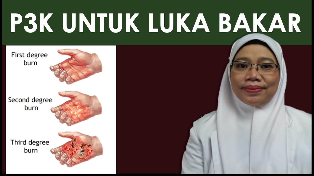 P3K untuk Luka Bakar