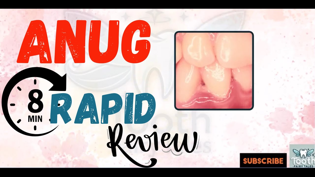ANUG , Acute Necrotizing Ulcerative Gingivitis, Acute gingival infections