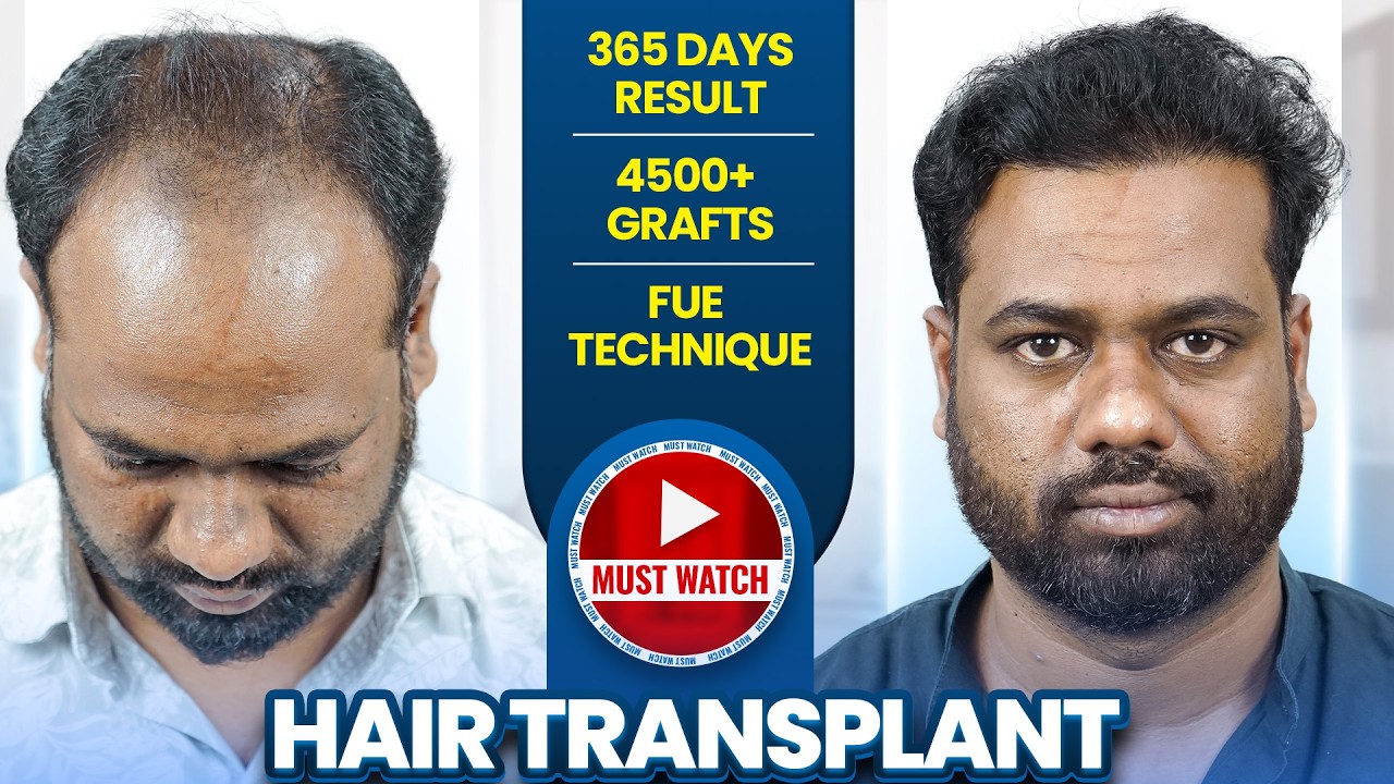 Extreme Baldness Solved | 4500 Grafts FUE | Nagpur