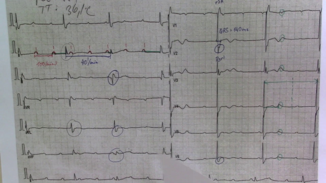 EKG 3