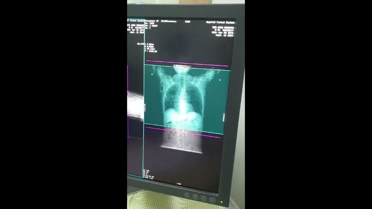 Scanner Radiothérapie du Cancer du Poumon