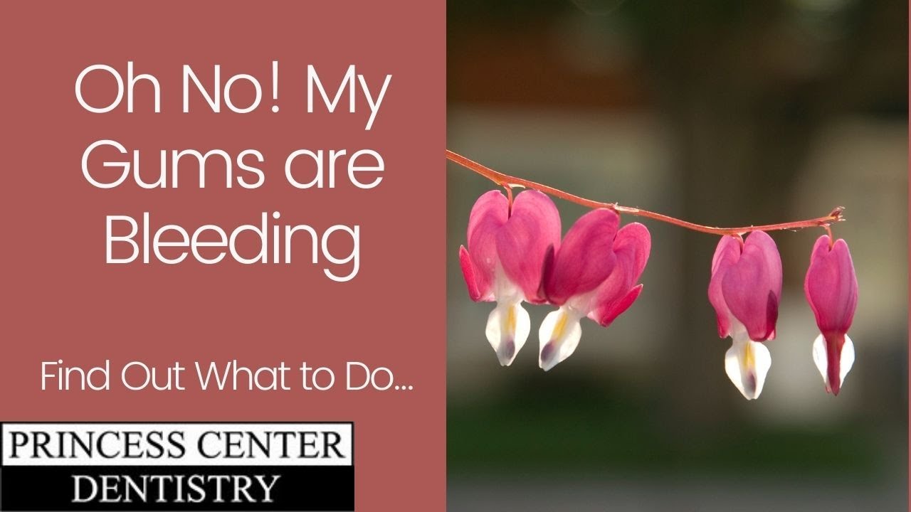 Oh No! My Gums are Bleeding! (Find Out What to Do...)