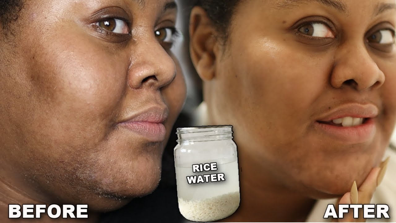 RICE WATER ON MT FACE FOR 30 DAYS Before + After Photos