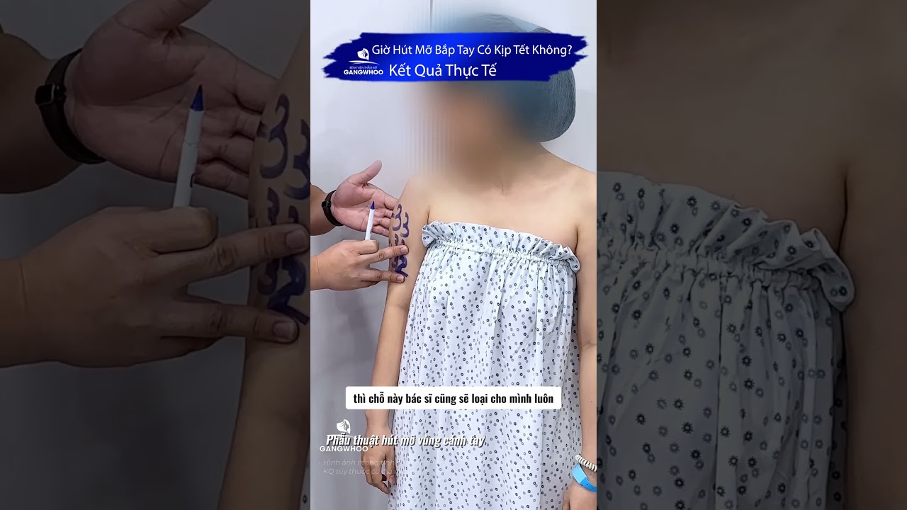 Giờ Hút Mỡ Bắp Tay Có Kịp Tết Không? Kết Quả Thực Tế Ai Cũng Bất Ngờ 😱 