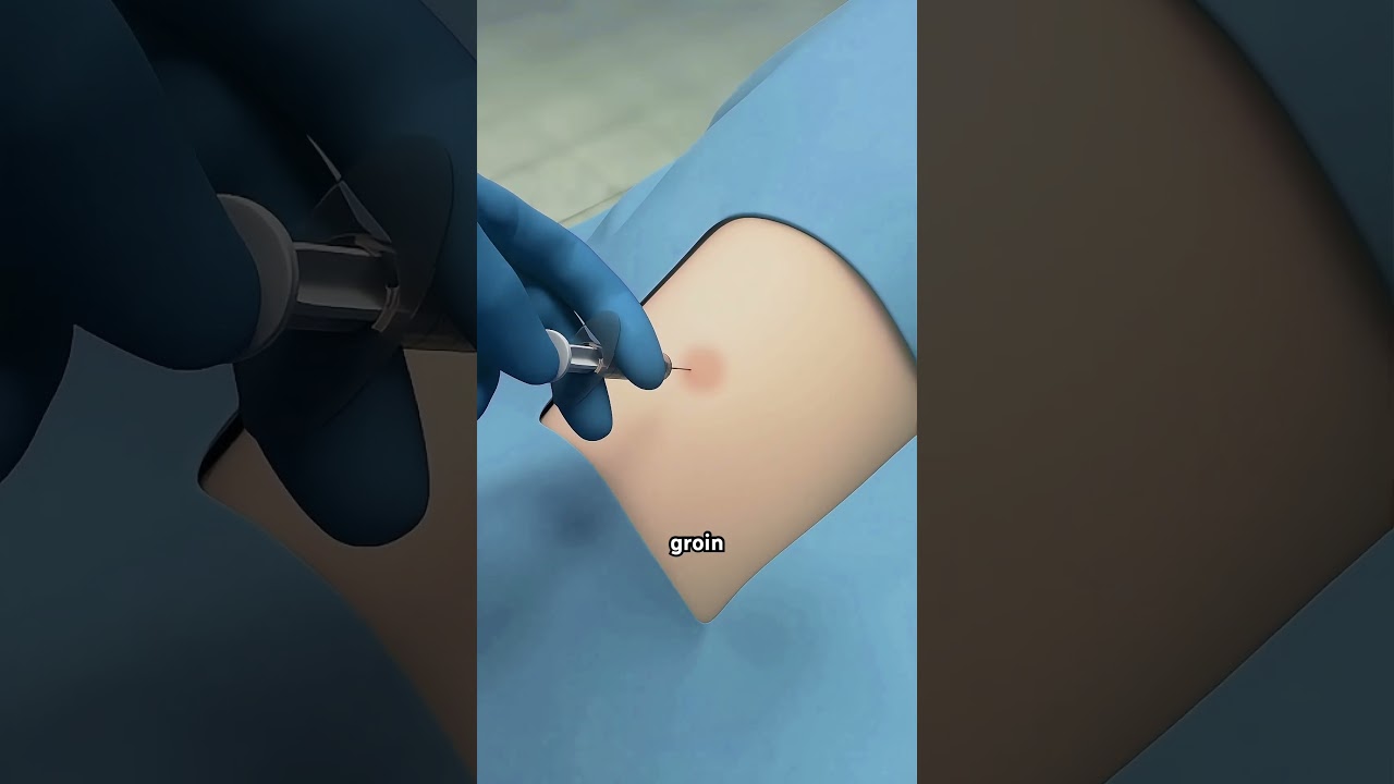 How Rotational Atherectomy Is Done? #artificialheart #structuralheart #aorticvalvestenosis