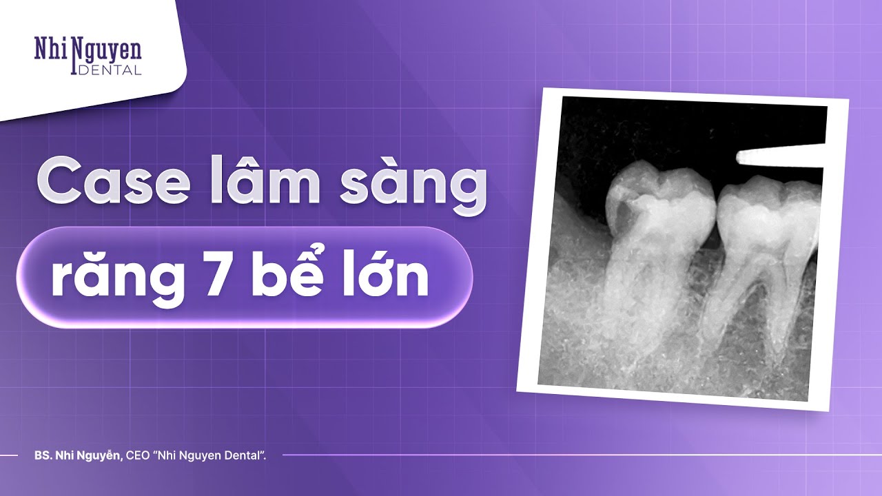 Review Ca Lâm Sàng: Điều Trị Tuỷ Sống Bằng Bioceramic Và Inlay Toàn Sứ Răng 7
