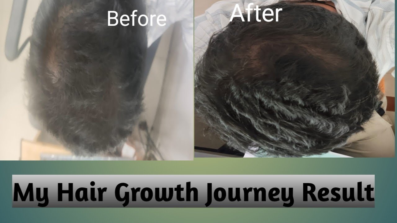 My Hair growth Result #hairHair growth Review/Kera-FM 5% Result🔥#minoxidilresult #minoxidil
