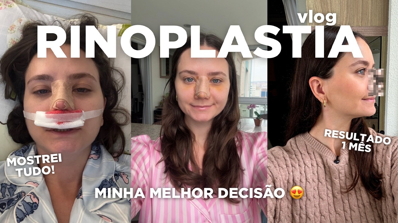 FIZ uma RINOPLASTIA! O pós foi difícil, mas VALEU A PENA 😭✨ | Vlog real