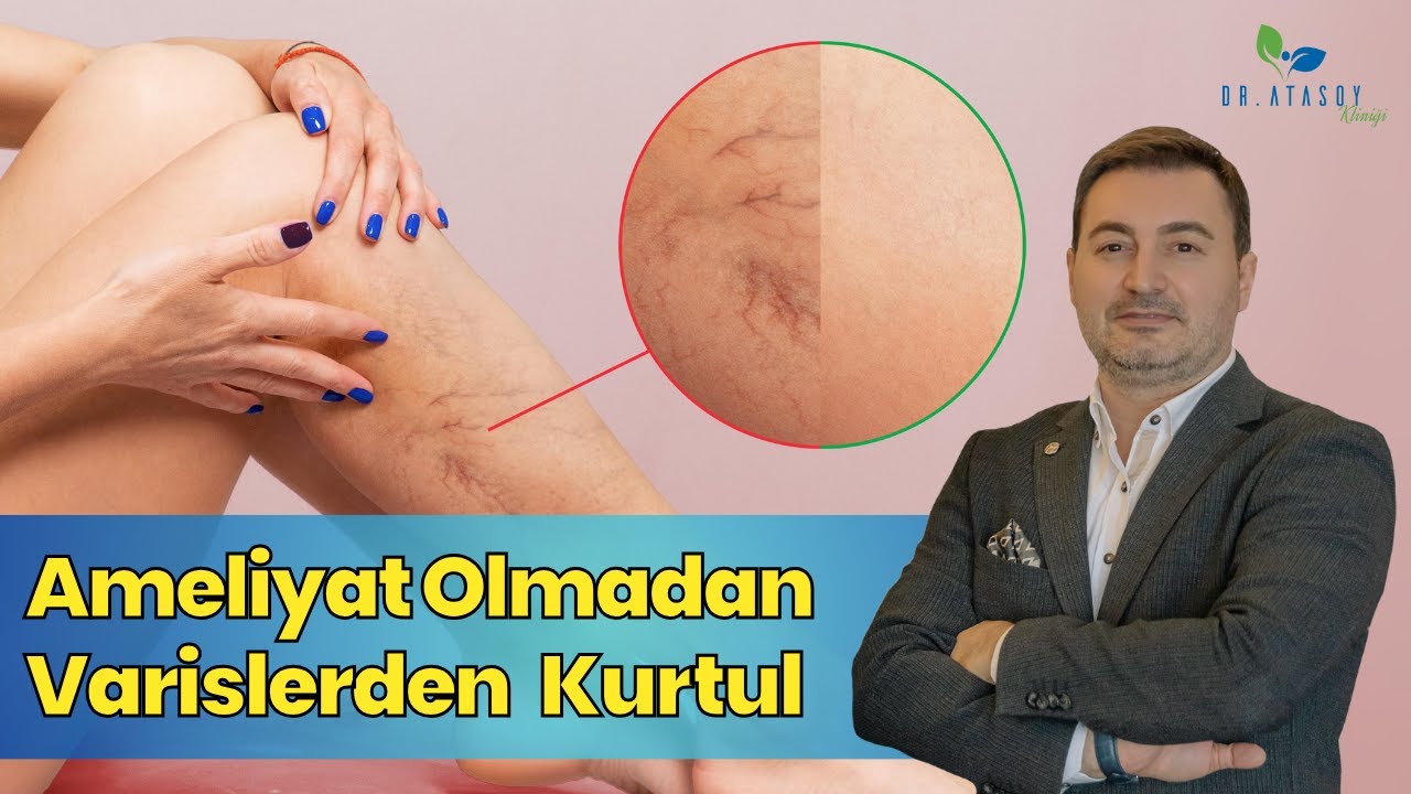 Devrim Niteliğindeki Varis Tedavisi: Ameliyata Gerek Yok!