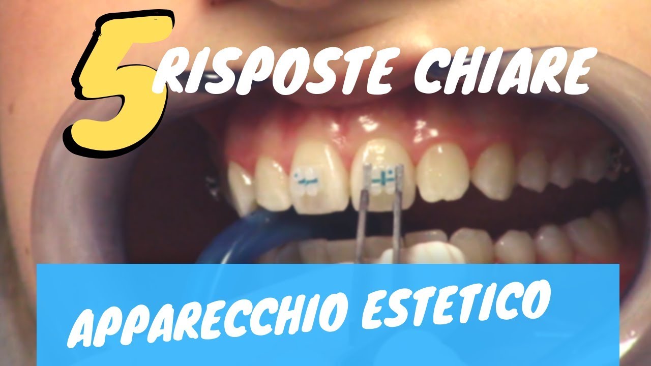 5 risposte CHIARE sull'apparecchio ESTETICO