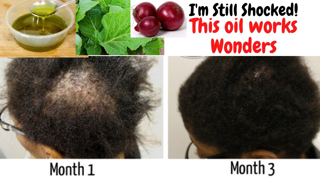 😱🔥Use Only Once A Week And Your Hair Will Like Crazy! Regrow Bald Spots, Thicken Your Hair Fast