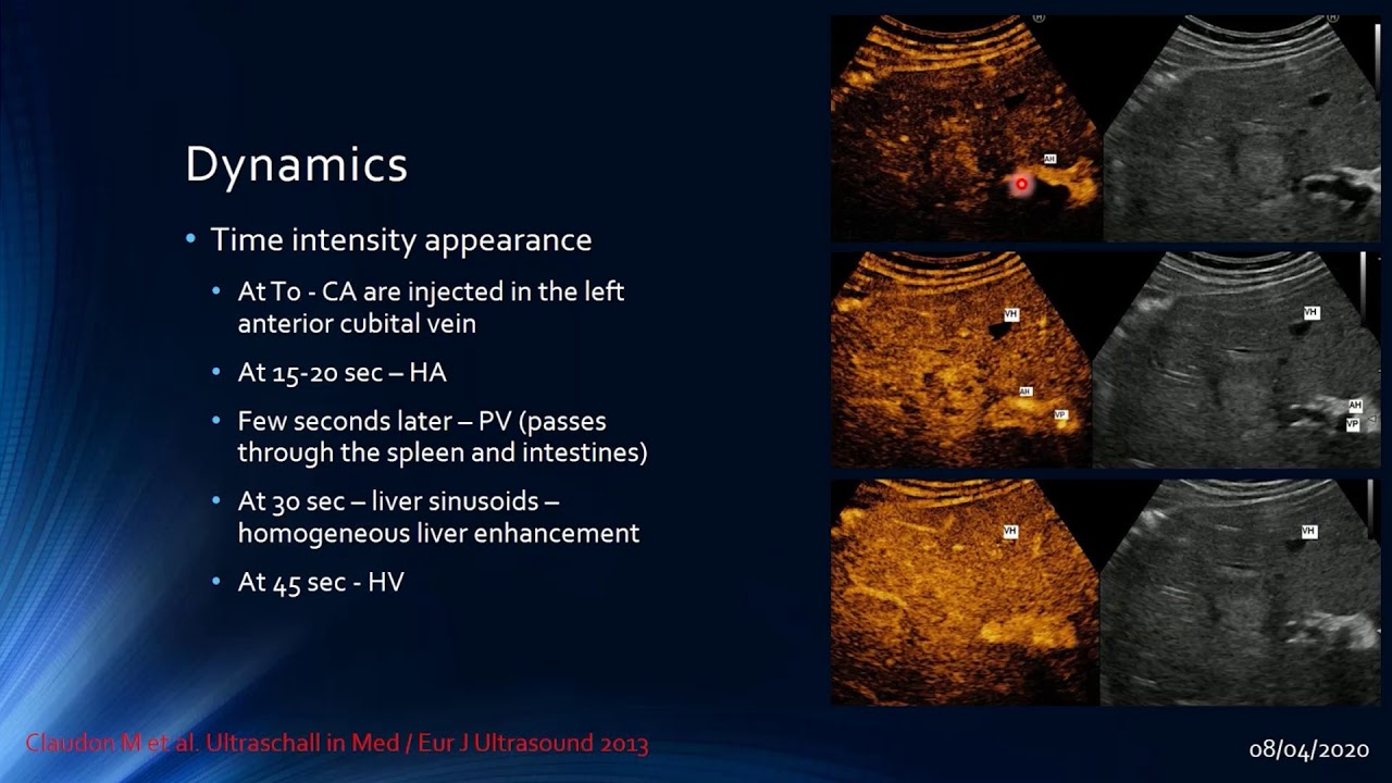 EFSUMB Webinar: CEUS in Liver Imaging 08-04-2020 - A.Saftiou