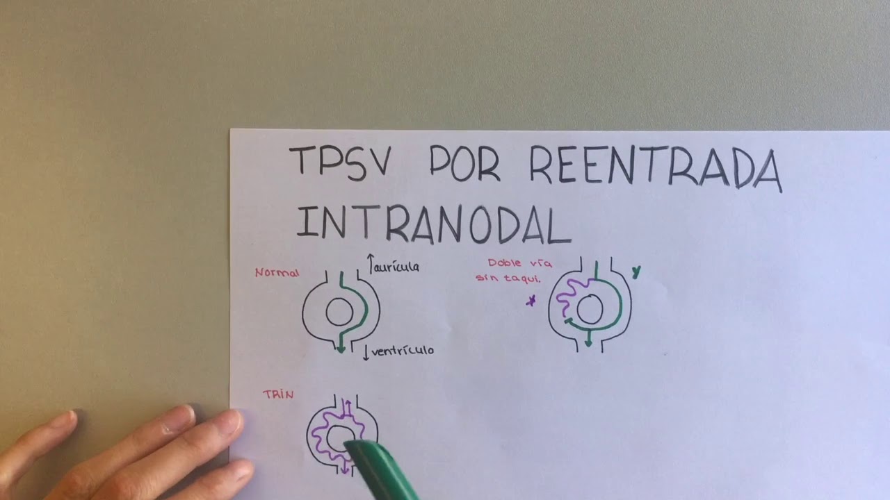 TAQUICARDIA por REENTRADA INTRANODAL