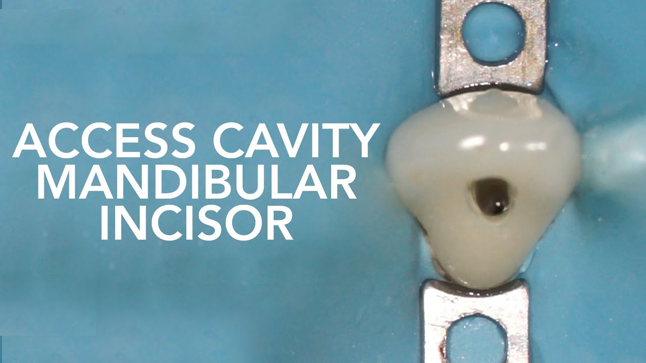 Pre Clinical Endodontic - Access Cavity of Mandibular Incisor