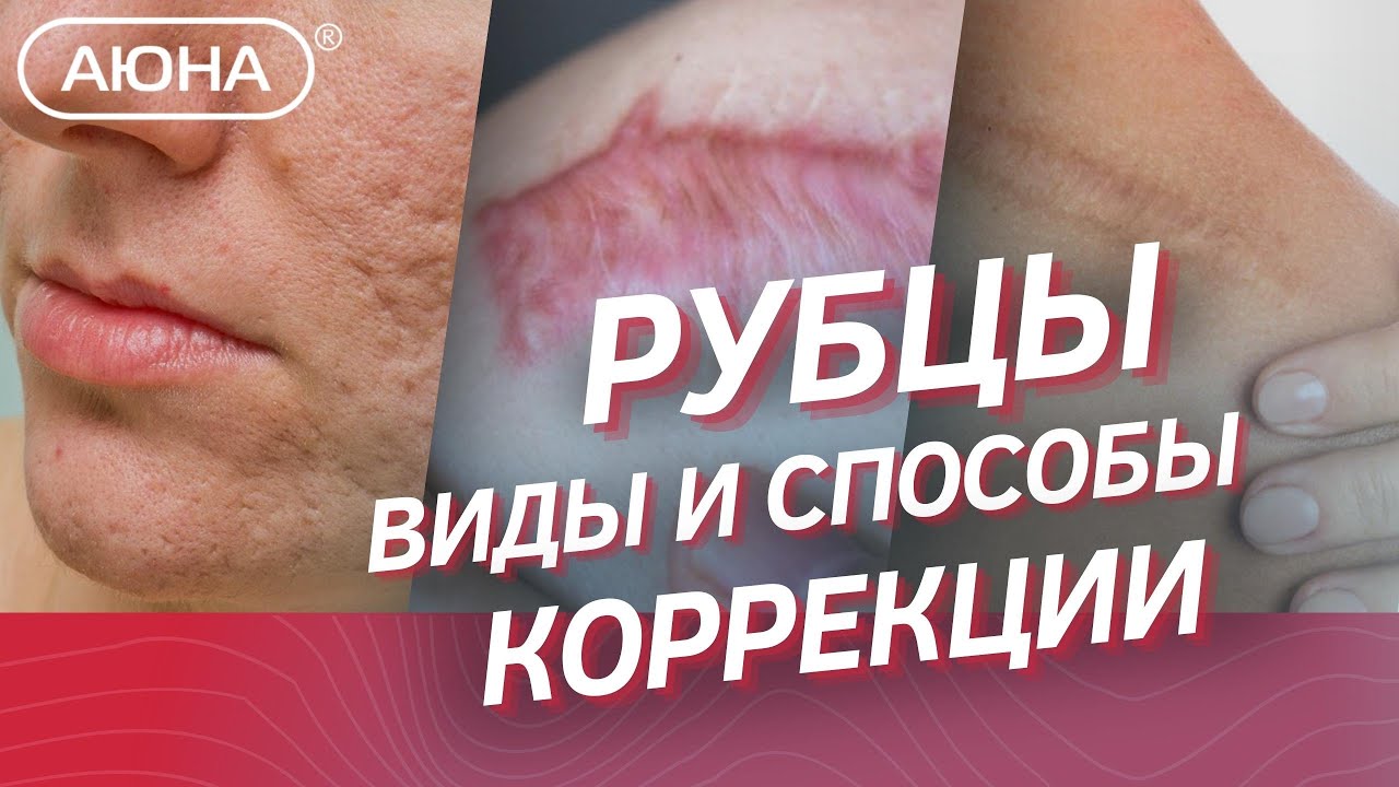 Рубцы на коже / Типы рубцов и способы коррекции. Формирование рубцов постакне, разбор этапов.