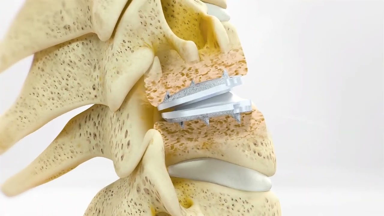 Centinel Spine: prodisc&reg; C Vivo Surgical Technique (2022)