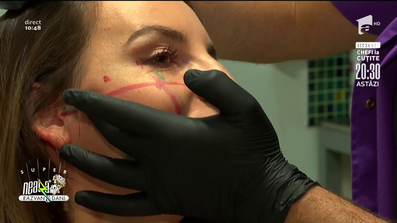Tratamente estetice de ridicare a pometilor - Dr. Morad Iancu, clinica Luxury Aesthetics