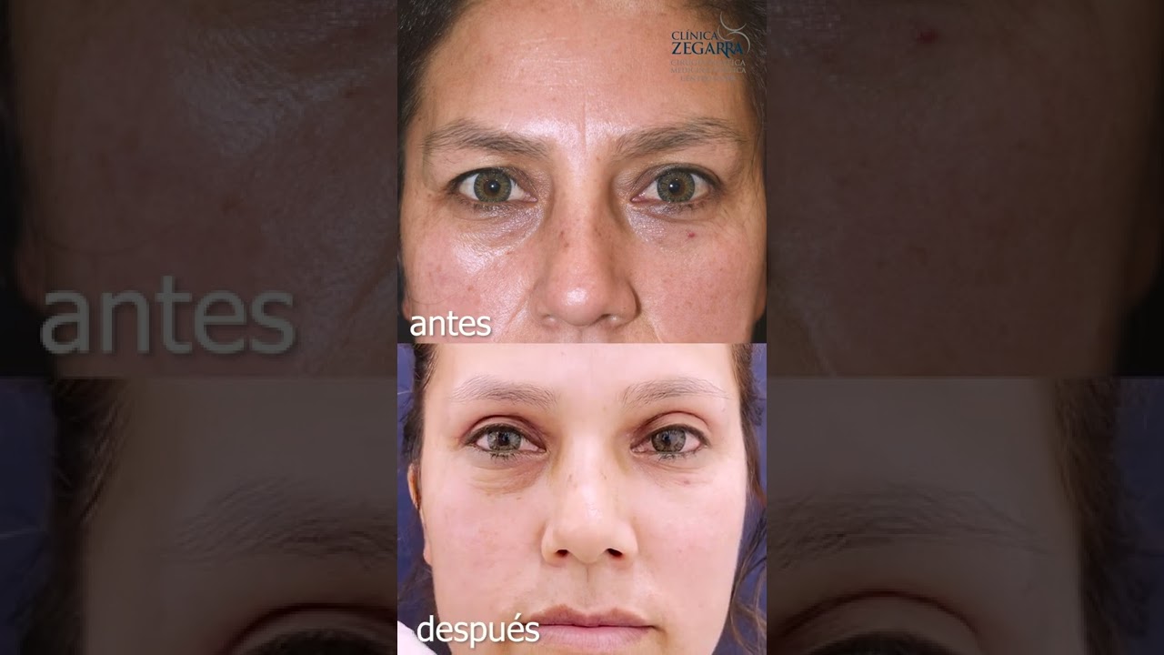BLEFAROPLASTIA + LIPOIMPLANTE FACIAL // ANTES Y DESPUÉS
