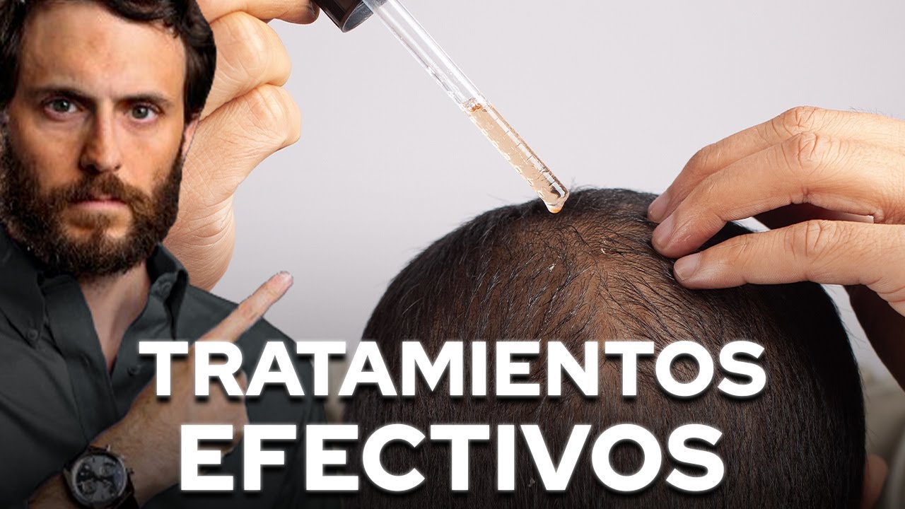 Alopecia SOLUCIONES REALES para EVITAR la P&Eacute;RDIDA de PELO