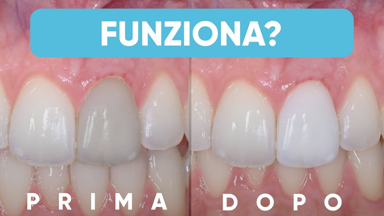 Lo Sbiancamento Dentale funziona davvero?