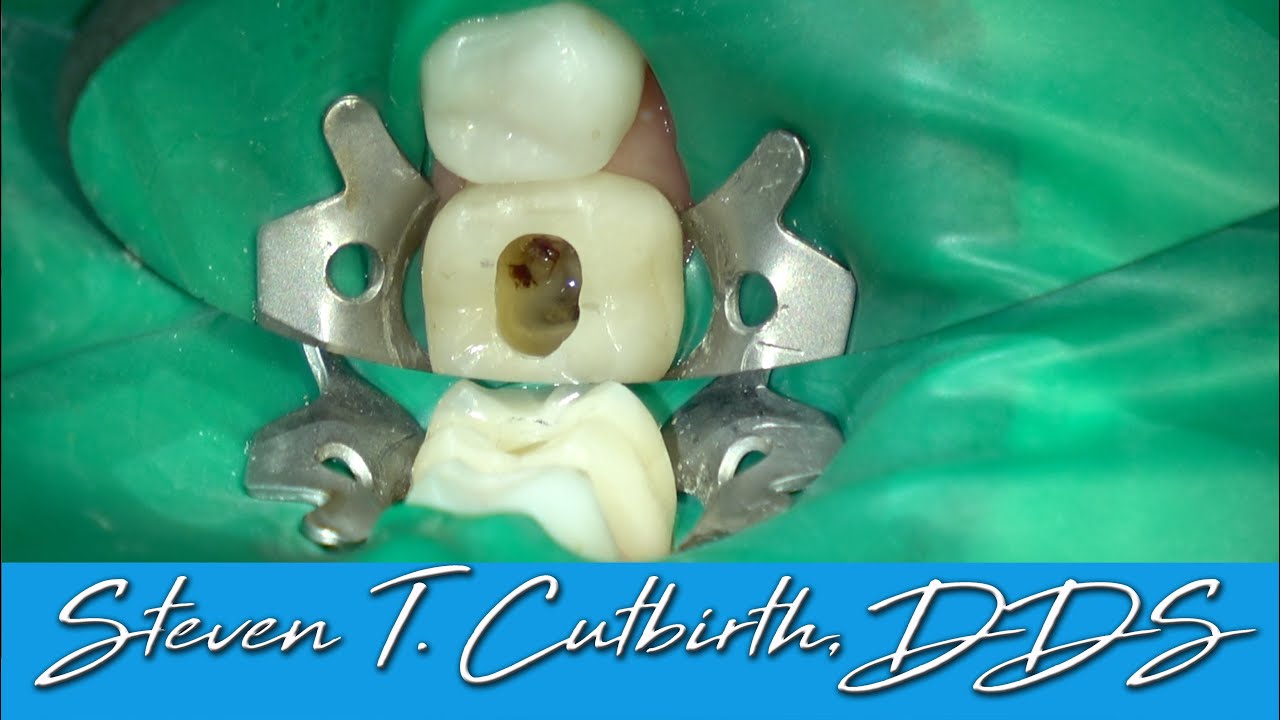 Endo Through a Molar Crown - with Steven T. Cutbirth, DDS