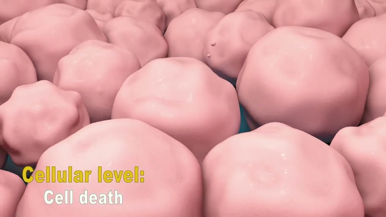 Treatments for Neuroendocrine Tumors