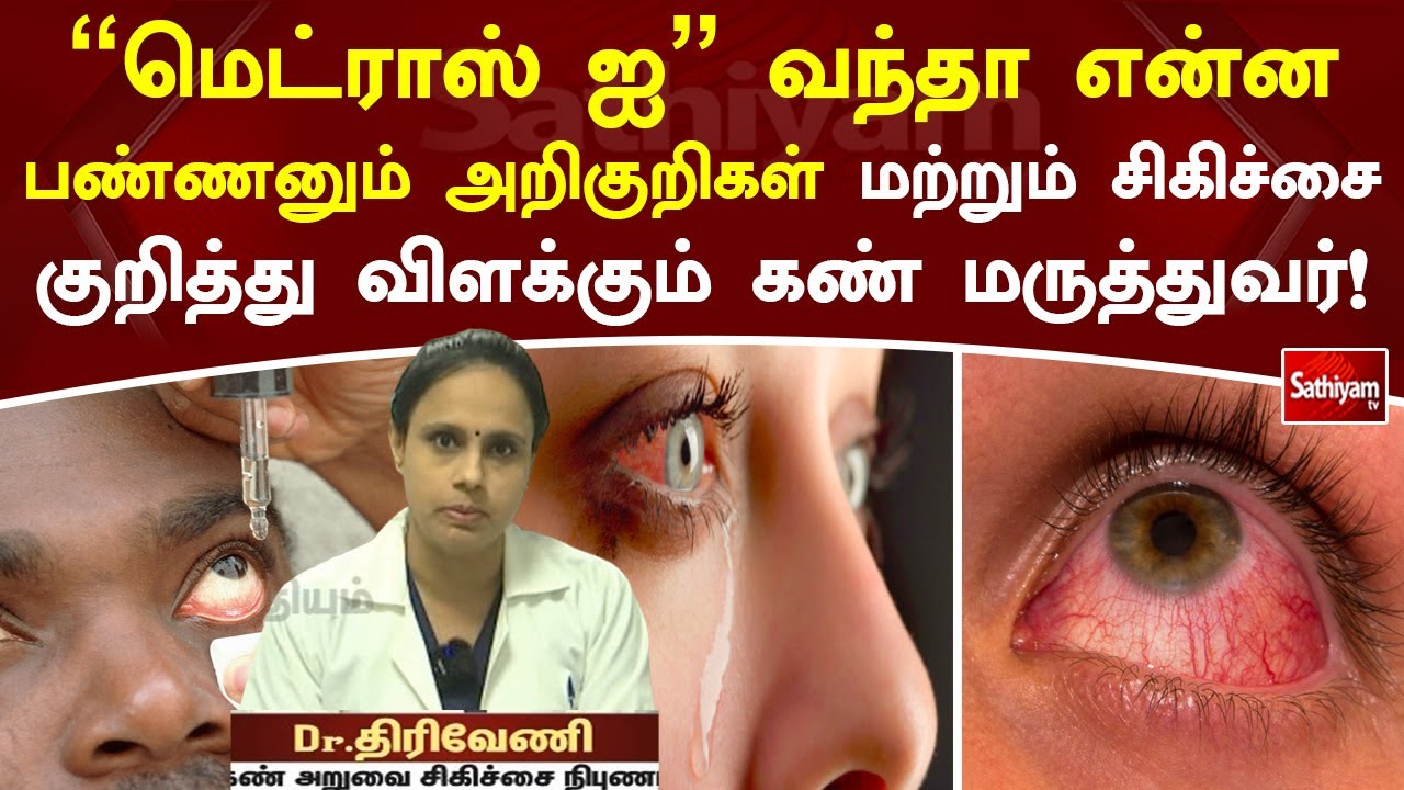 “மெட்ராஸ் ஐ” வந்தா என்ன பண்ணனும் அறிகுறிகள் மற்றும் சிகிச்சை குறித்து விளக்கும் கண் மருத்துவர்!