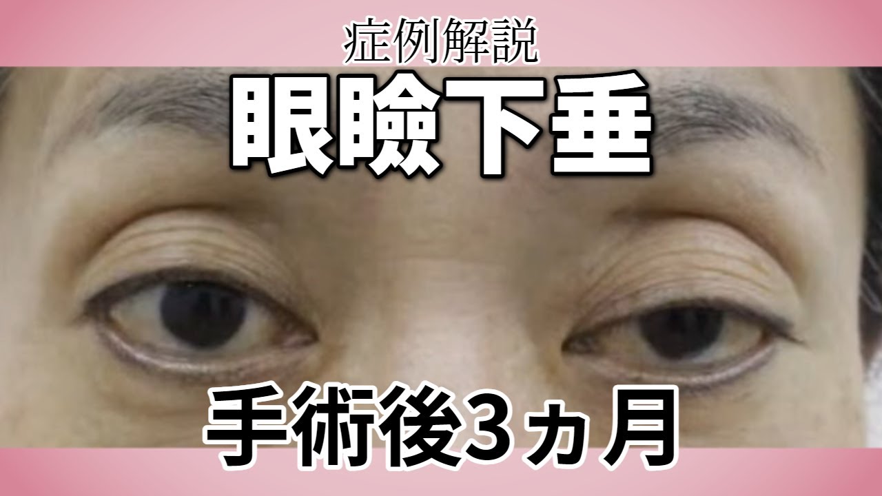 眼瞼下垂の手術後3カ月の症例解説