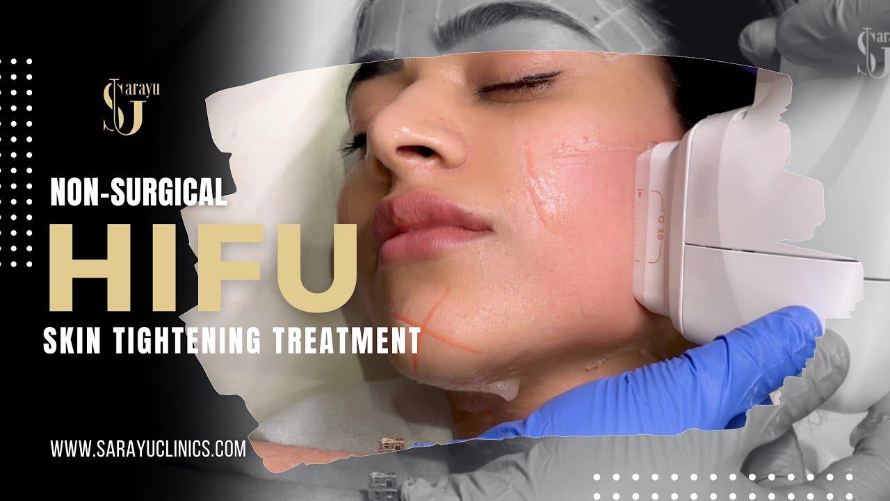 HIFU Non-Surgical Facelift : Tightened Face Without Surgery | Sarayu Clinics #hifu