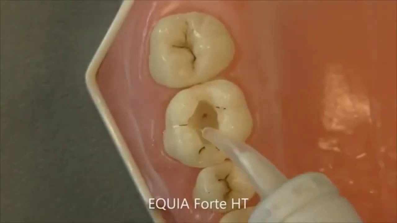 Stamp technique with EQUIA Forte HT