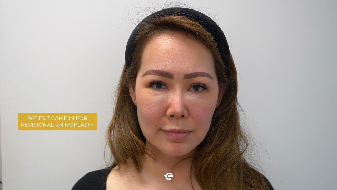 Patient Journey: Rhinoplasty | Beverly Hills | Plastic Surgery