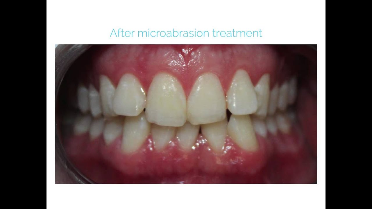 Enamel Microabrasion