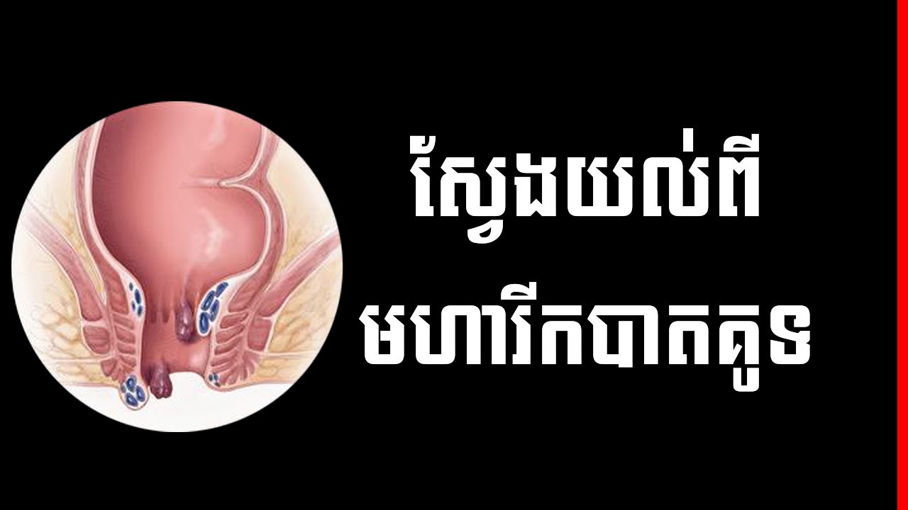ឬសដូងបាត៖ ស្វែងយល់ពីដុំសាច់មហារីកនៅបាតគូទ វេជ្ជបណ្ឌិត ម៉ៅ ម៉េងលន់