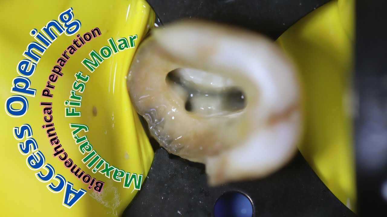 access opening 🟢 maxillary first molar 🔵