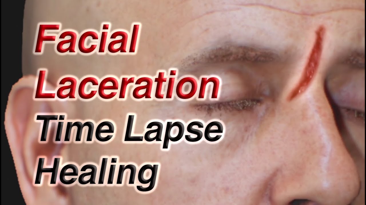 Facial Laceration Time Lapse Healing via Secondary Intention