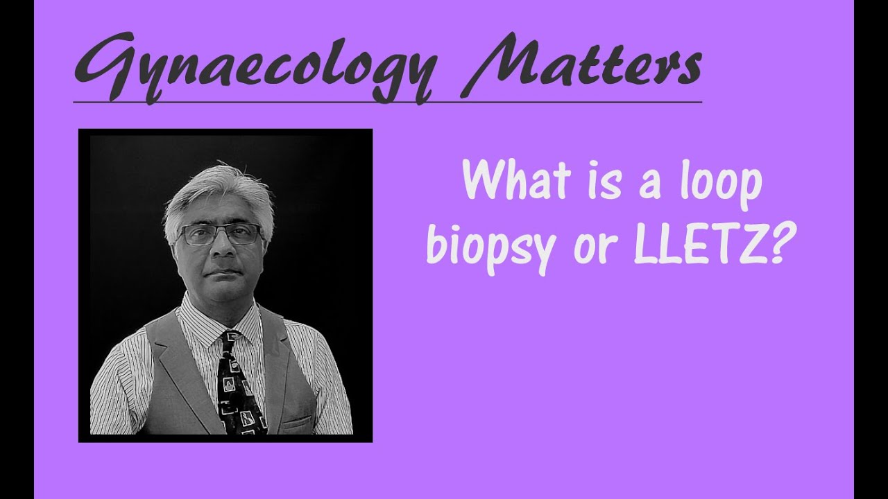 What is a loop biopsy of cervix or LLETZ?